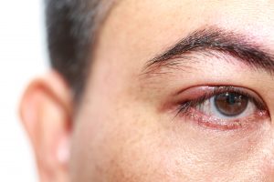 Síntomas de la retinopatía diabética2