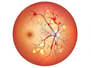 retinopatia-diabetica-proliferativa