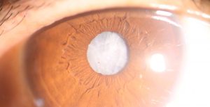Enfermedades oculares derivadas de la diabetes: Catarata