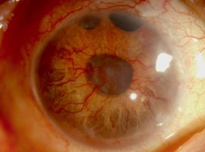 Enfermedades oculares derivadas de la diabetes: Glaucoma Neovascular