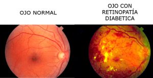 Enfermedades oculares derivadas de la diabetes: Retinopatía Diabética (RD)